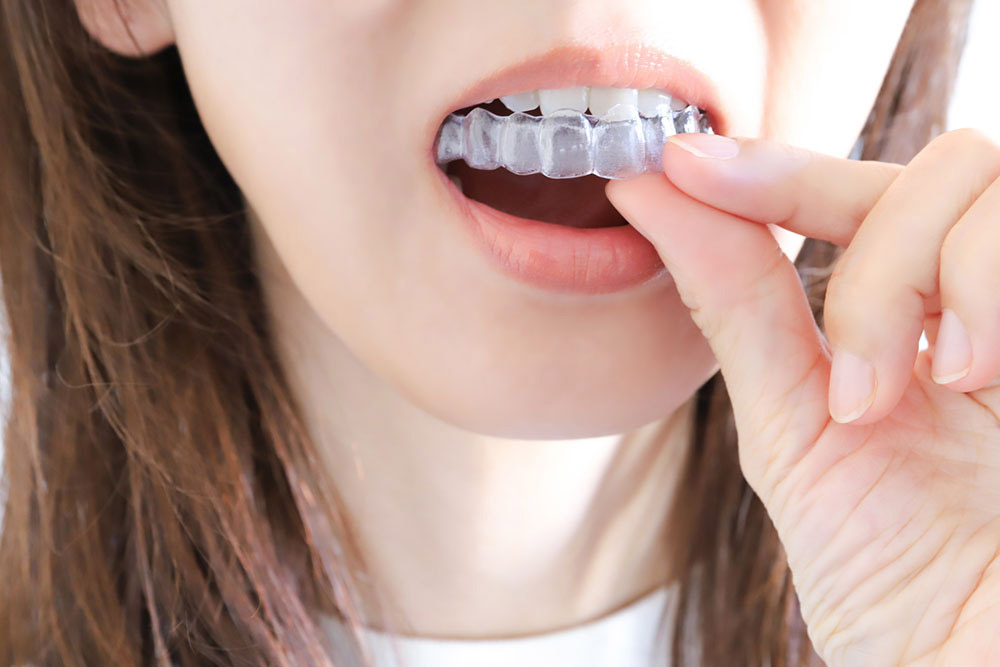 インビザライン