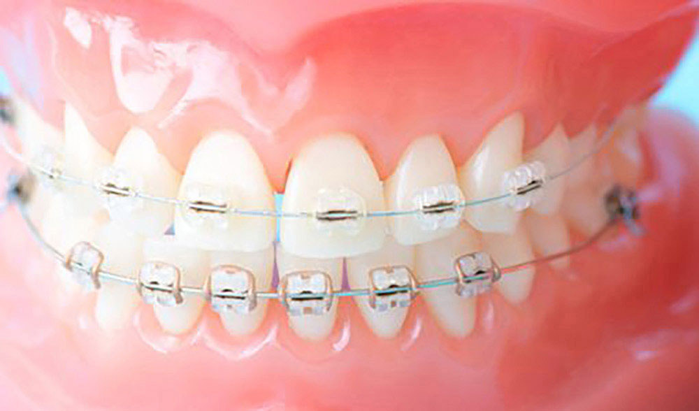 ワイヤー矯正（クリアブラケット）